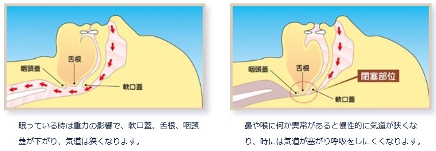 睡眠時無呼吸症候群の解説イラスト